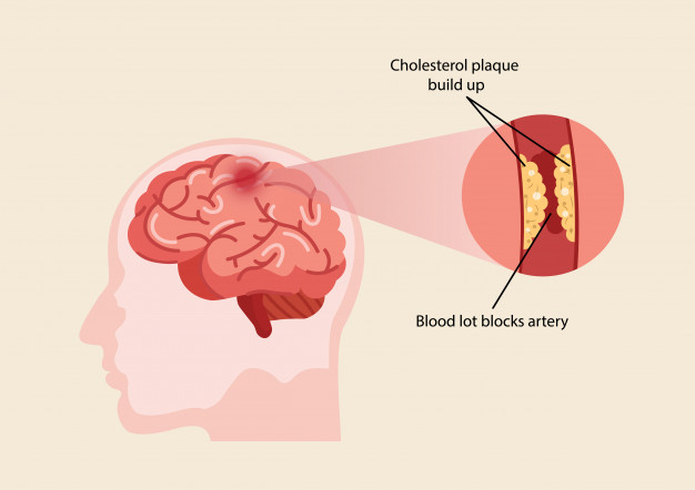 human-brain-stroke-illustration SIMS Hospital
