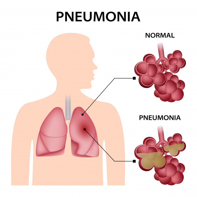 Pneumonia | Lung inflammation - Symptoms and Diagnosis
