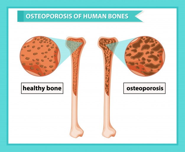 Osteoporosis Pictures Of Bones