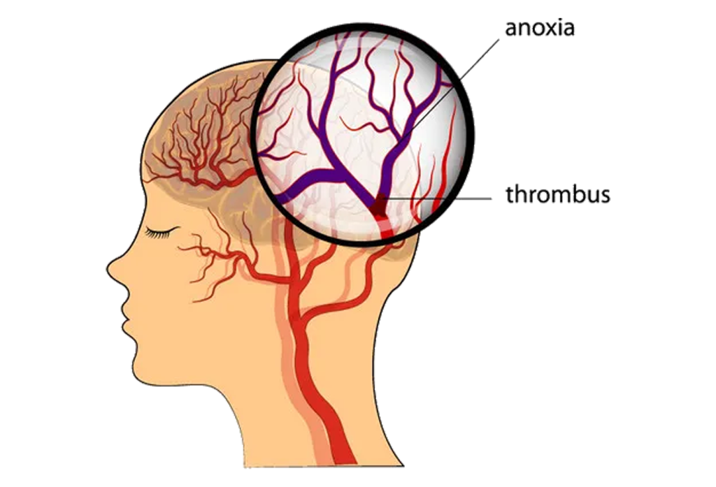 Best Hospital for Brain Stroke Treatment In Chennai